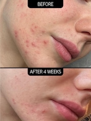 The INKEY List 2% NovoRetin Blemish Clearing Moisturiser 50ml - Image 3 of 4