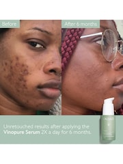 Caudalie Vinopure Blemish Control Salicylic Serum - 30 mL - Image 4 of 5
