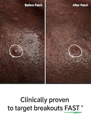 The INKEY List Hydrocolloid Pimple Patches 22pcs - Image 2 of 4