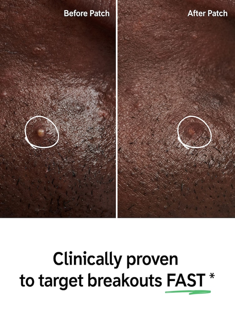 The INKEY List Hydrocolloid Pimple Patches 22pcs - Image 2 of 4