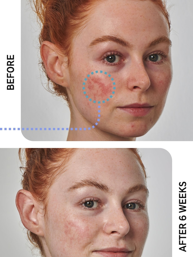 The INKEY List Super Solutions 10% Azelaic Acid Serum 30ml - Image 2 of 5