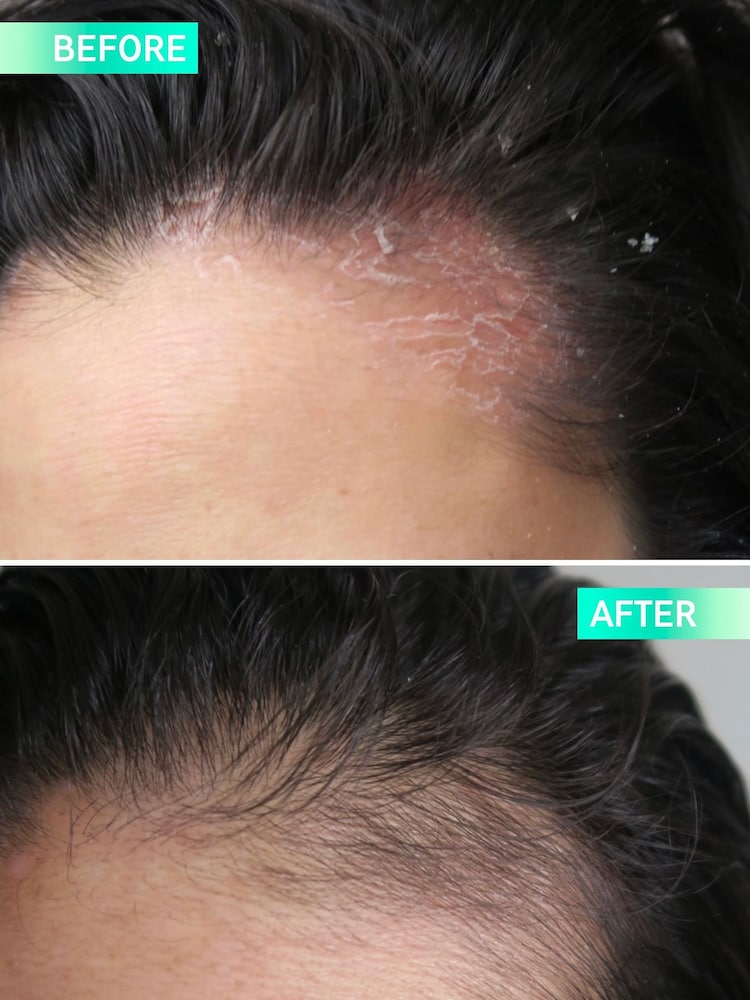 The INKEY List Salicylic Acid Exfoliating Scalp Treatment 150ml - Image 2 of 4