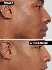 The INKEY List Mandelic Acid Treatment 15ml - Image 3 of 4