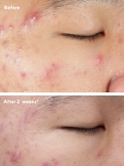 Murad Deep Relief Blemish Treatment Serum 30ml - Image 2 of 5