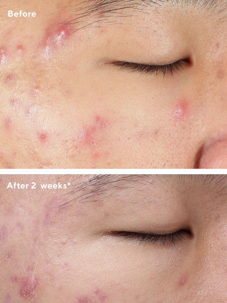Murad Deep Relief Blemish Treatment Serum 30ml - Image 2 of 5