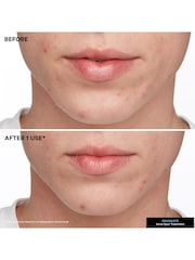 Kate Somerville EradiKate Acne Treatment  30 ml / 1 fl oz Blemish Treatment as seen in UK market - Image 4 of 9