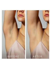 FOREO Peach™ 2 - Permanent Hair Reduction IPL Device with Skin Cooling System - Image 6 of 7
