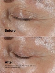Clinique Smart Clinical Repair Wrinkle Correcting Eye Cream 15ml - Image 3 of 5