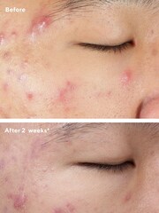 Murad Deep Relief Blemish Treatment 30ml - Image 2 of 5