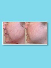 Murad Daily Clarifying Peel 95ml - Image 4 of 5